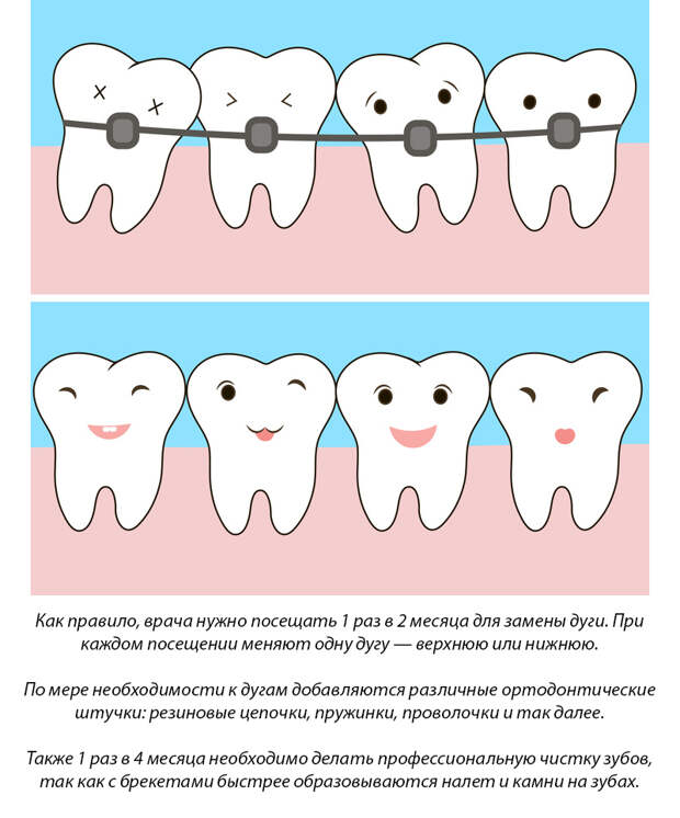 11 фактов о брекетах, которые нужно знать перед их установкой