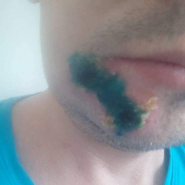 В Подмосковье зарегистрирован случай заражения оспой обезьян