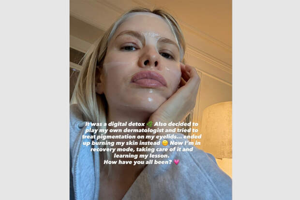 Бывшая возлюбленная российского миллиардера сожгла себе глаз