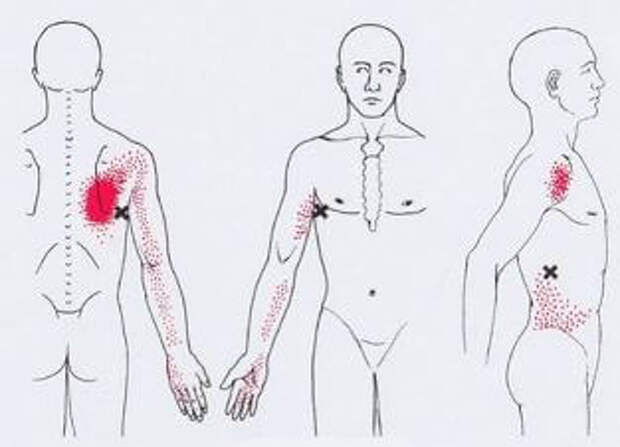 Карта точек боли в теле и точек напряжения мышц триггеры
