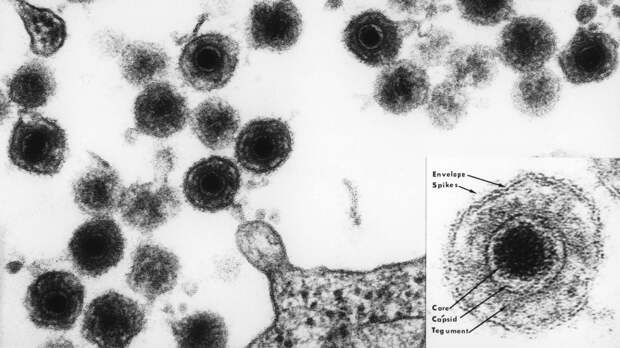 Скрывающиеся в мозге вирусы герпеса могут связывать сотрясения мозга и деменцию
