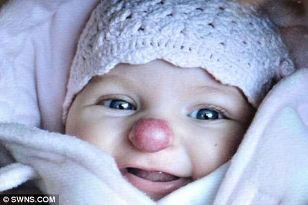 Юная британка, которая родилась с пятном на носу, помогает людям с изъянами внешности