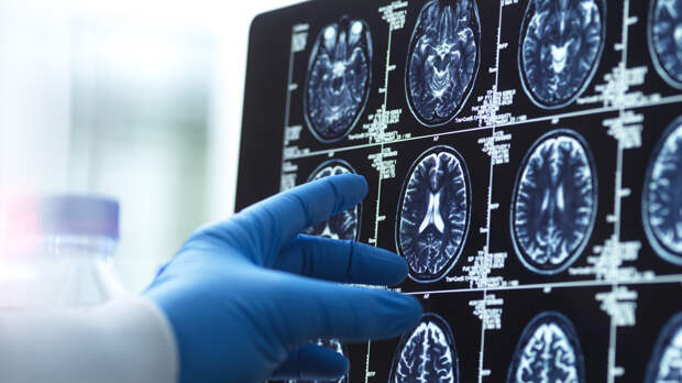 Врач Штань: распознать признаки деменции помогут специальные тесты