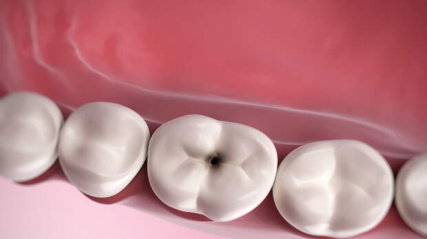 Россиянам рассказали, можно ли унаследовать склонность к кариесу