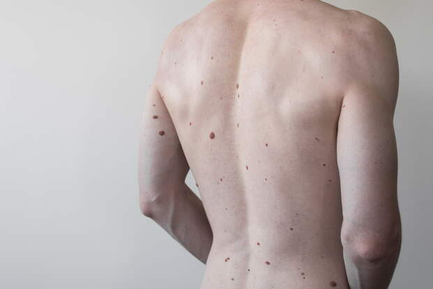 Male,Torso,With,A,Lot,Of,Moles,,Spine.,Athletic,Body