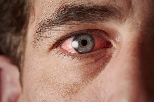 Врач Левина: лопнувшие сосуды в глазах могут появляться из-за диабета