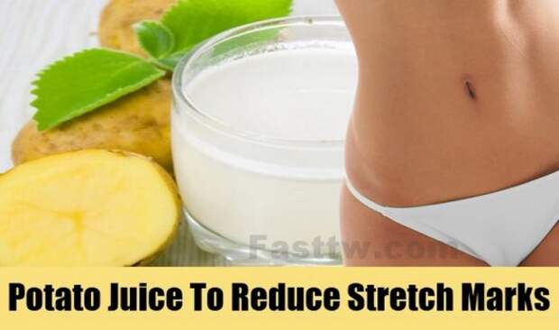 Potatoes Contain A Lot Of Vitamins Help Eliminate Stretch Marks
