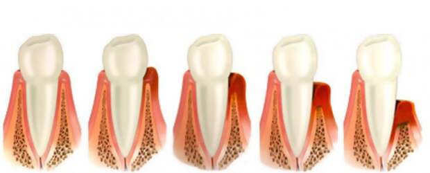 Народное лечение пародонтоза зубов и десен 