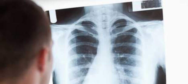 В Чехии активно распространяется туберкулёз. Медики увязывают эпидемию с наплывом украинцев