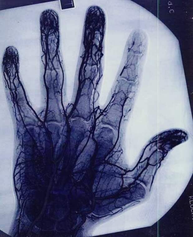 Ангиограмма показывает поврежденные сосуды указательного пальца мастера по йо-йо. взгляд изнутри, необычные вещи, новый ракурс, фото