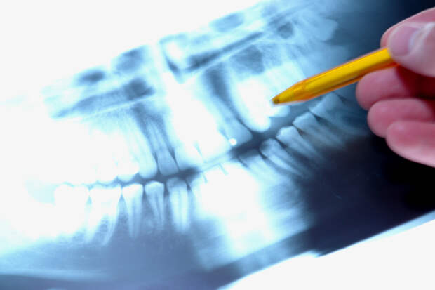 Стоматолог предупредила: запущенный кариес может привести к смерти