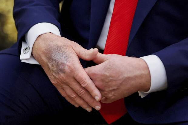 WSJ: Трамп скрывает гримом синяки и другие физические признаки старения