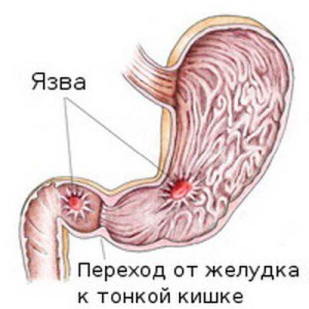 что такое язва