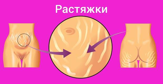 как убрать растяжки на попе