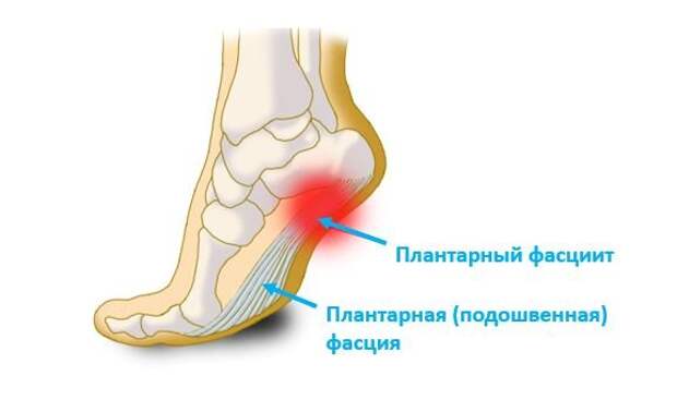 Плантарный фасциит. Лечение в Тюмени