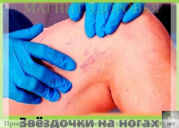 Звёздочки на ногах: как от них избавиться. Звёздочки на ногах: как от них избавиться.