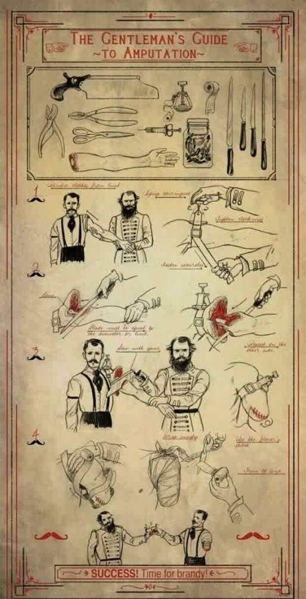 ампутация, инструкция