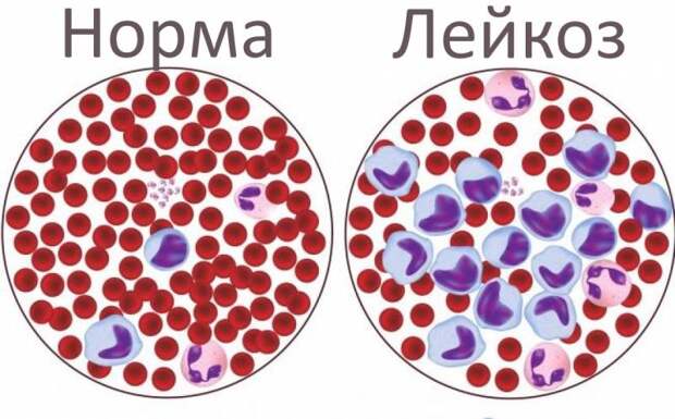 Гиперпластический синдром: симптомы, диагностика, лечение