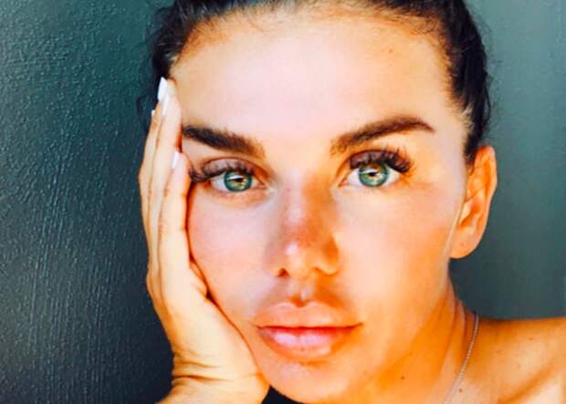 Анна Седокова опухла от старой болезни и покрылась безобразными пятнами — врачи откачивают капельницами