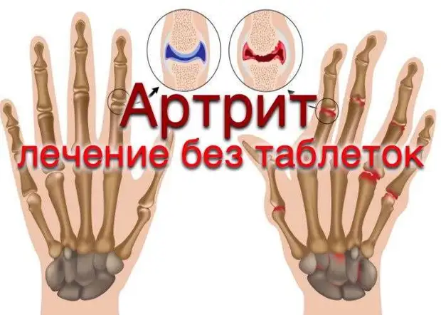 ЛЕЧЕНИЕ АРТРИТА