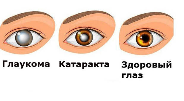 катаракта и глоукома