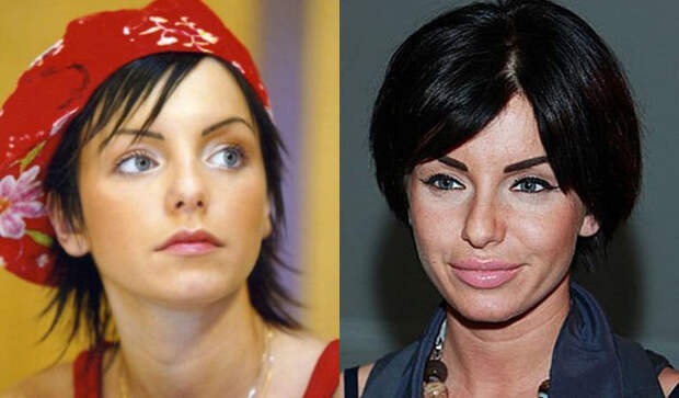 Экс участница группы “t.A.t.U” неожиданно сделала себе серию операций. После того, как девушка сделала себе татуаж бровей — выщипала себе их и нарисовала заново, она решилась на серьёзный шаг: увеличила объем губ. О, ужас — неудачно. Губы Юли словно расплывались по лицу, и она не могла их удержать даже повторными инъекциями. Кстати, эффект «пельменей» со временем сошел на нет, и теперь на Волкову даже можно смотреть без сострадания. Грудь Юли — тоже не совершенство. Силиконовые имплантанты живут словно сами по себе. Говорят также, что недавно девушка сделала себе новый разрез глаз. И почему-то кажется, что на этом эксперименты над телом «татушка» не закончит...