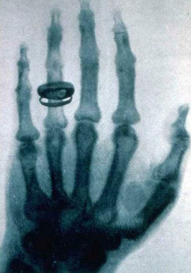 Первый рентгеновский снимок. | Фото: Википедия.