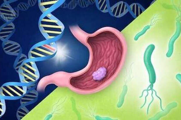 Medical Xpress: дробное питание снижает риск рака желудка при "плохой генетике"