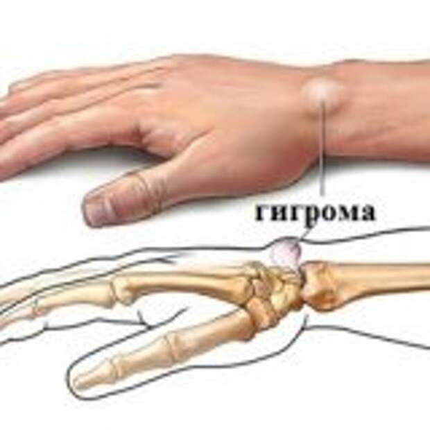 Народные методы лечения гигромы
