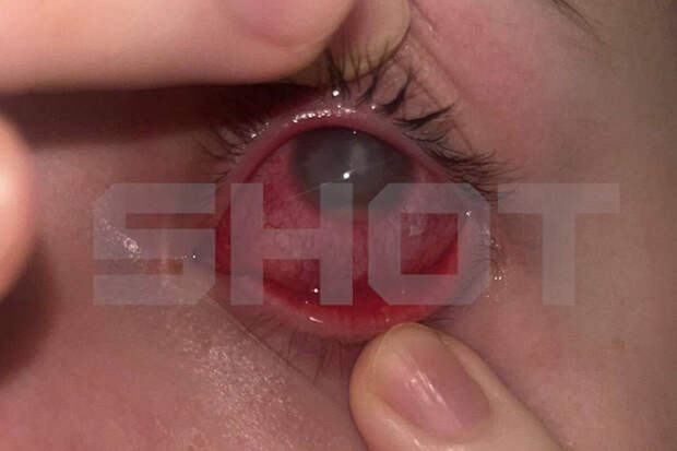 SHOT: в Новосибирске девушка лишилась глаза, неудачно надев линзы