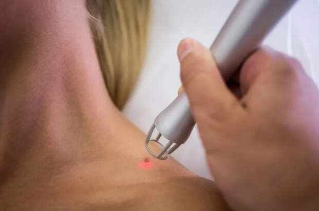 Жительница Ирландии заболела раком кожи из-за посещения солярия