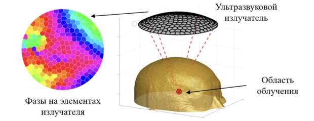 Физики улучшили метод неинвазивной хирургии мозга