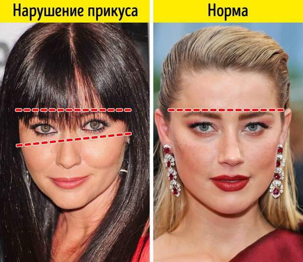 Как неправильный прикус влияет на самочувствие и внешность