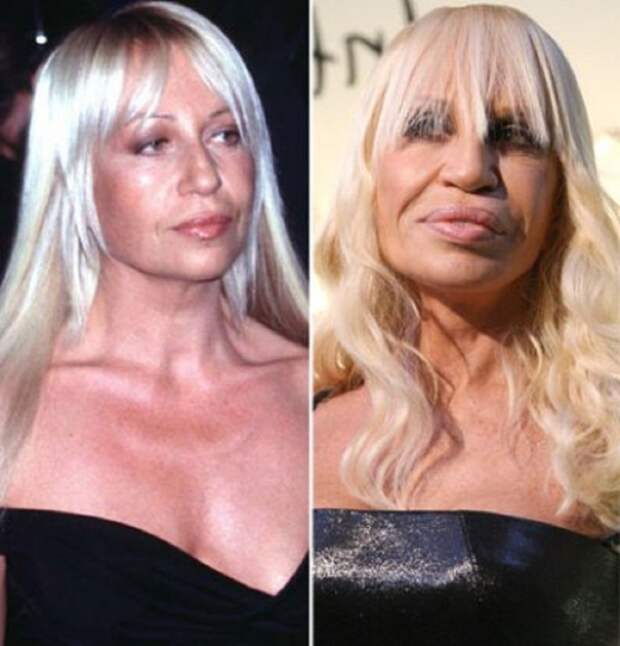 Donatella-Versace-Plastic-Surgery-Before-and-After-Lip-Augmentation