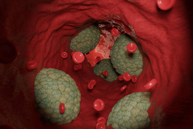 NatMed: генотерапию впервые применили для снижения уровня "плохого" холестерина