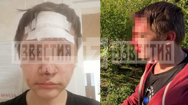 Проломили голову: фото избитого бизнесменом мальчика в Петербурге