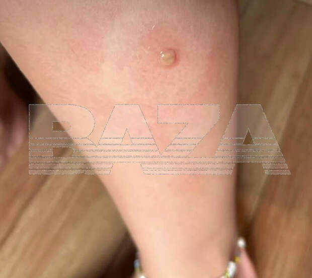 Россиянка подхватила инфекцию на Бали после укуса насекомого в ногу