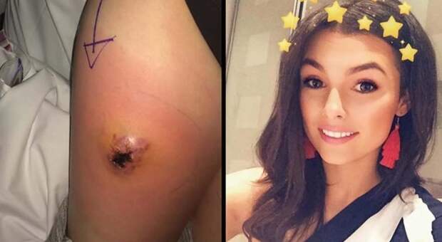 Страх потерять ногу после укуса паука заставил 19-летнюю девушку обратиться к врачам в мире, истории, люди, нога, паук, укус