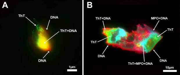 У пациентов с долгим COVID-19 нашли в крови множественные микротромбы