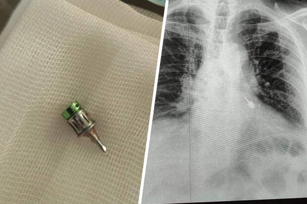 В Подмосковье у мужчины из бронха достали стоматологический бур