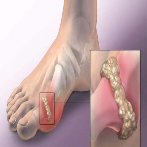 Подагра как выглядит фото Подагра: не относитесь легкомысленно! - Обсуждение статьи
