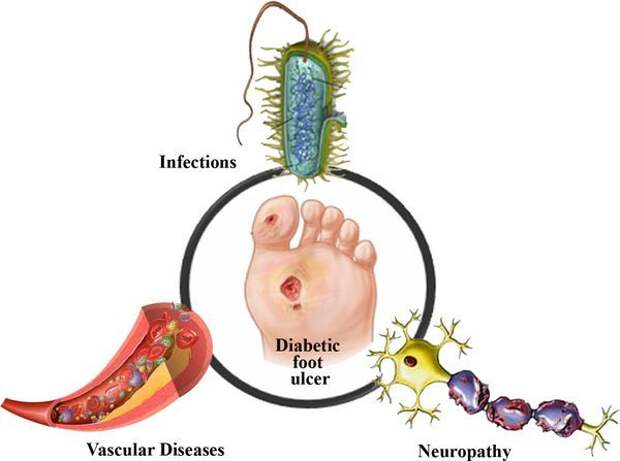 Диабетическая стопа: симптомы и лечение, стадии диабетической стопы, уход зав ногами при сахарном диабете