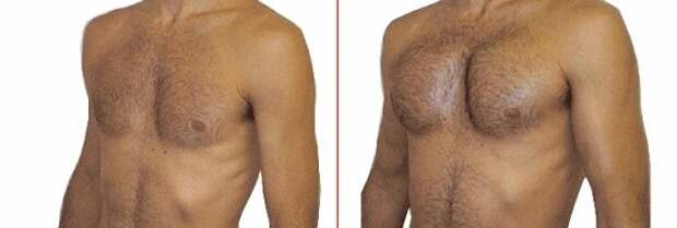 muscle-implant