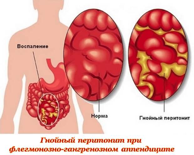 Перитонит при аппендиците