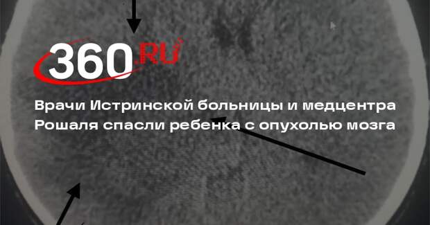 Врачи Истринской больницы и медцентра Рошаля спасли ребенка с опухолью мозга
